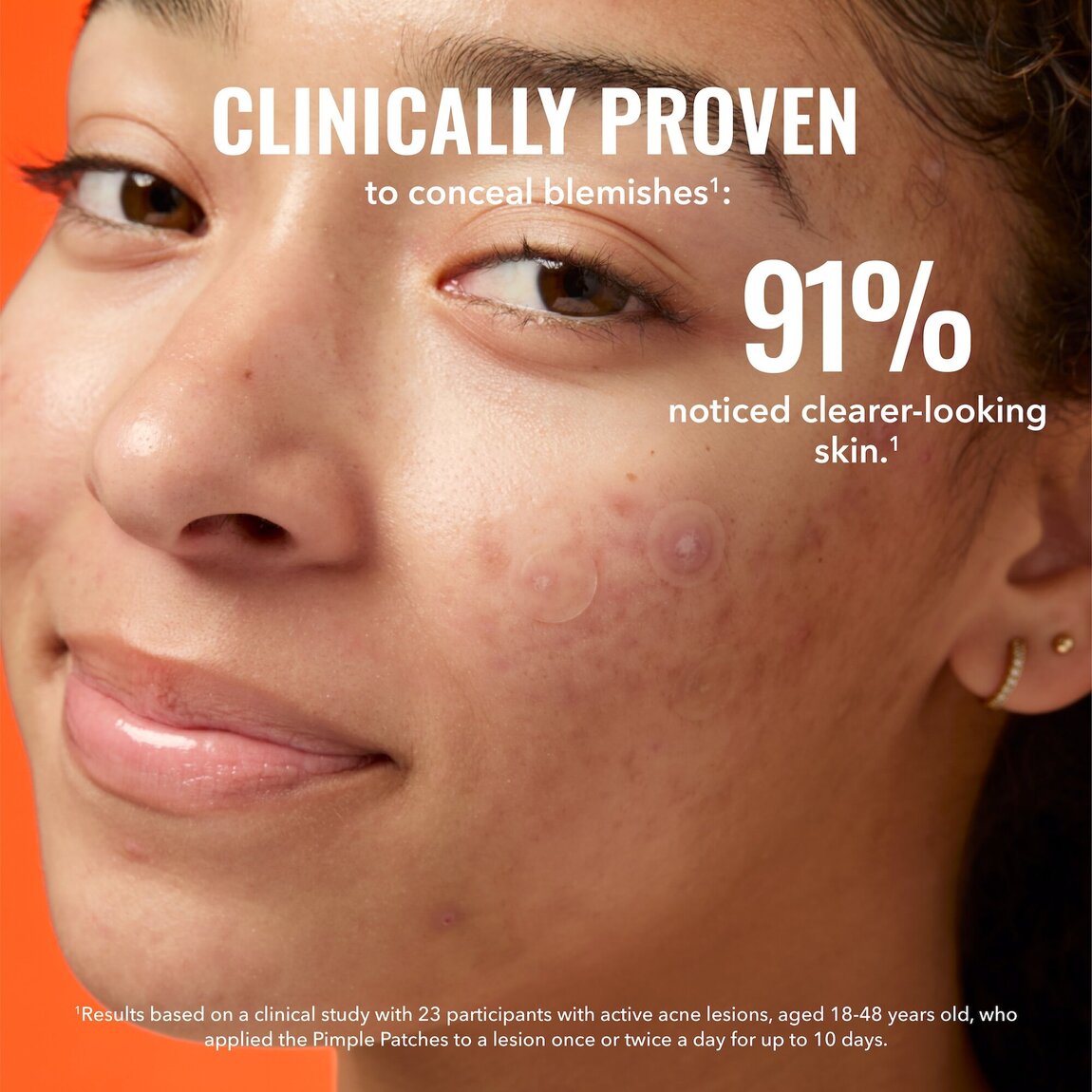pimple-patches-z3 zb_p.jpg