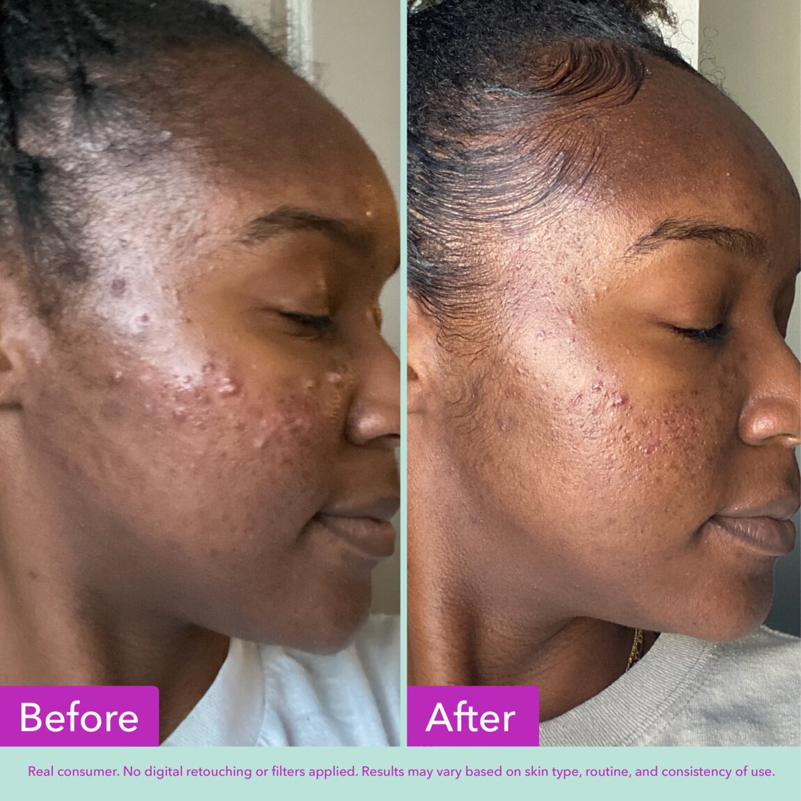 acne-foaming-cleanser-m8 zb_p.jpg
